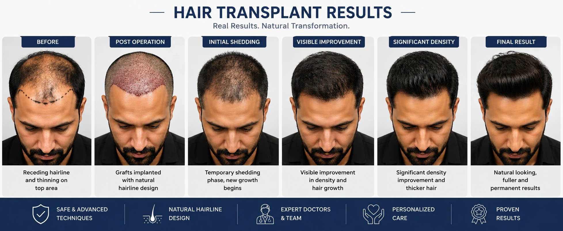 Hair Transplant Graft Assessment And Cost Planning In Jalgaon Section Four