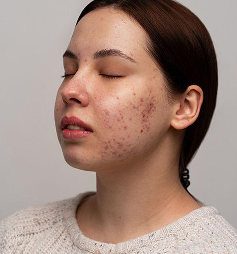 Melasma Treatment