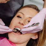 Dental Veneer Treatment