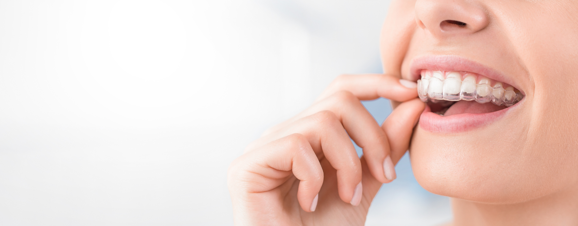 Invisalign treatment