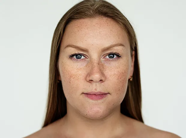 Types of Skin Pigmentation,featuring a woman with visible facial spots