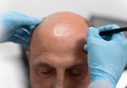 Hair Transplantation