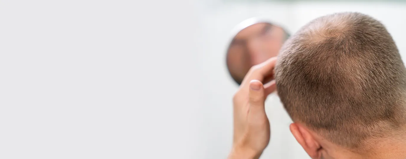 Scalp Micropigmentation (SMP) treatment for hair thinning at Dermatrix clinic in Mumbai and Thane 1376x540