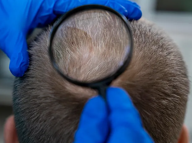 Scalp Micropigmentation (SMP) for Male Pattern Baldness treatment at Dermatrix clinic 620x460