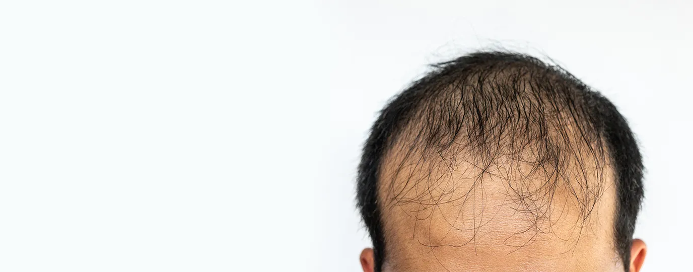 Close up of thinning hair on a scalp treated with Regenera Activa for hair regeneration 1376x540