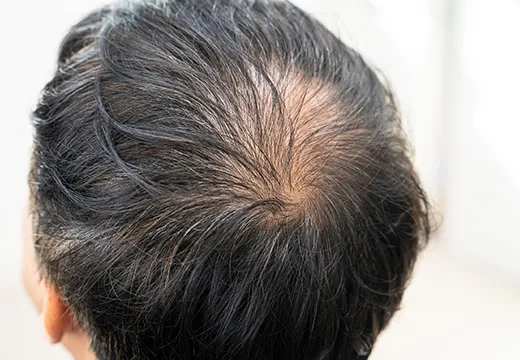 An image of a mans scalp with visible hair thinning and a bald spot on the crown, next to text describing Hair Regenera (Regenera Activa) hair loss treatment 520x360