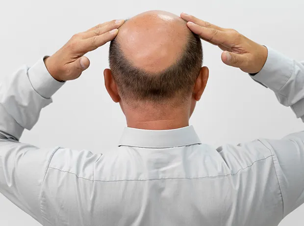 Patient demonstrating androgenetic alopecia and male pattern baldness at Dertmatrix hair loss clinic 620x460