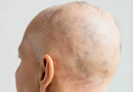 Person with patchy hair loss on scalp for alopecia treatment at Dermatrix clinic 520x360