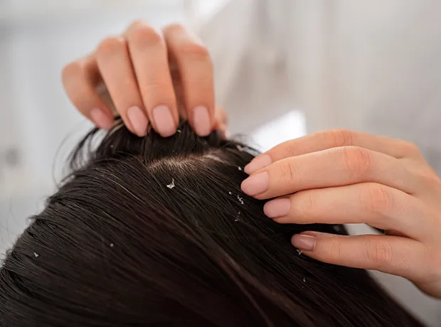 Dandruff types infographic with person checking dark hair for white flakes 620x460