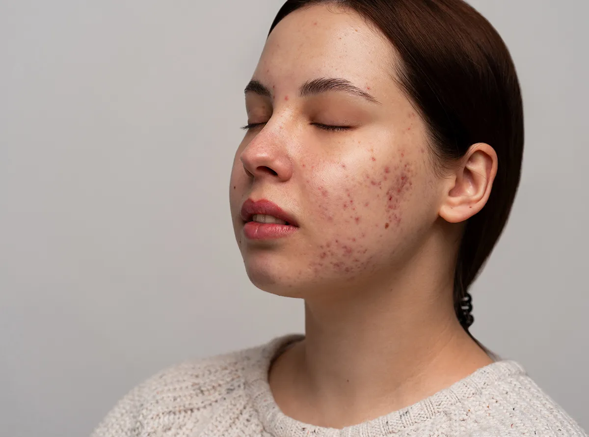Side profile of a woman with active acne and scars on her cheek before a Black Peel treatment 1200x890