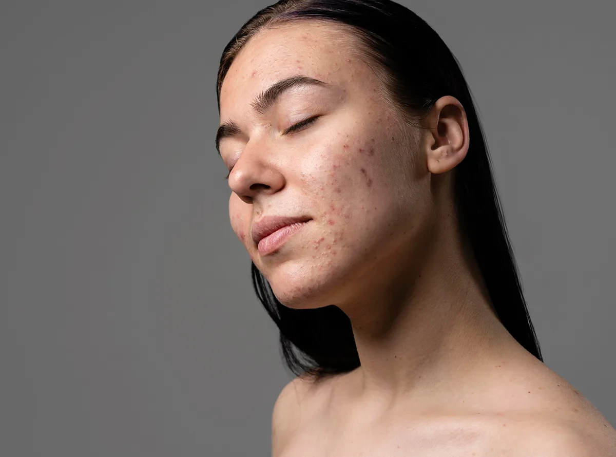 A webpage from Dermatrix titled Types of Pigmentation featuring an accordion list of conditions and an image of a woman with facial skin hyperpigmentation 1200x890