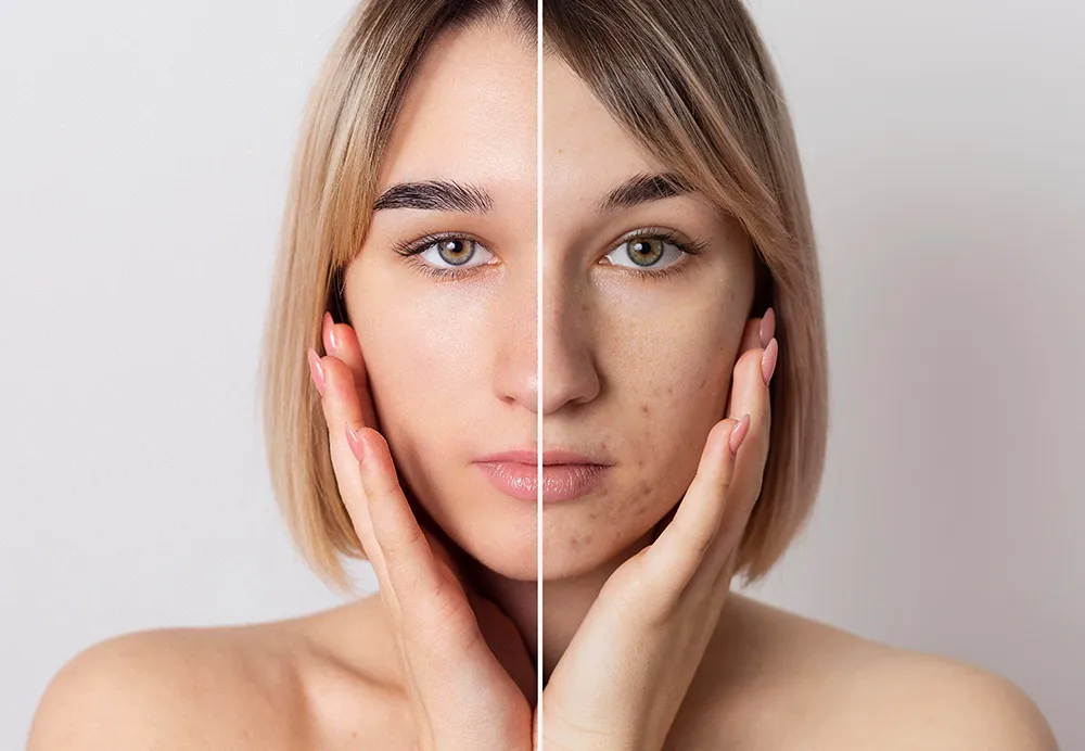 Before and after split view of a woman's face showing skin pigmentation and treatment results 1000x692
