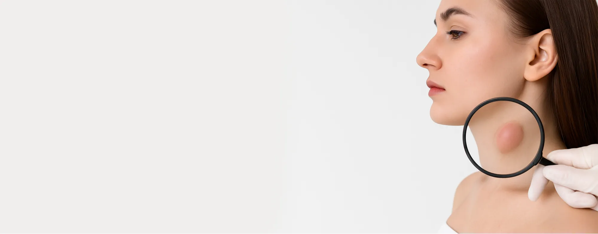 Cyst removal treatment at Dermatrix clinic in Thane and Mumbai 2000x785