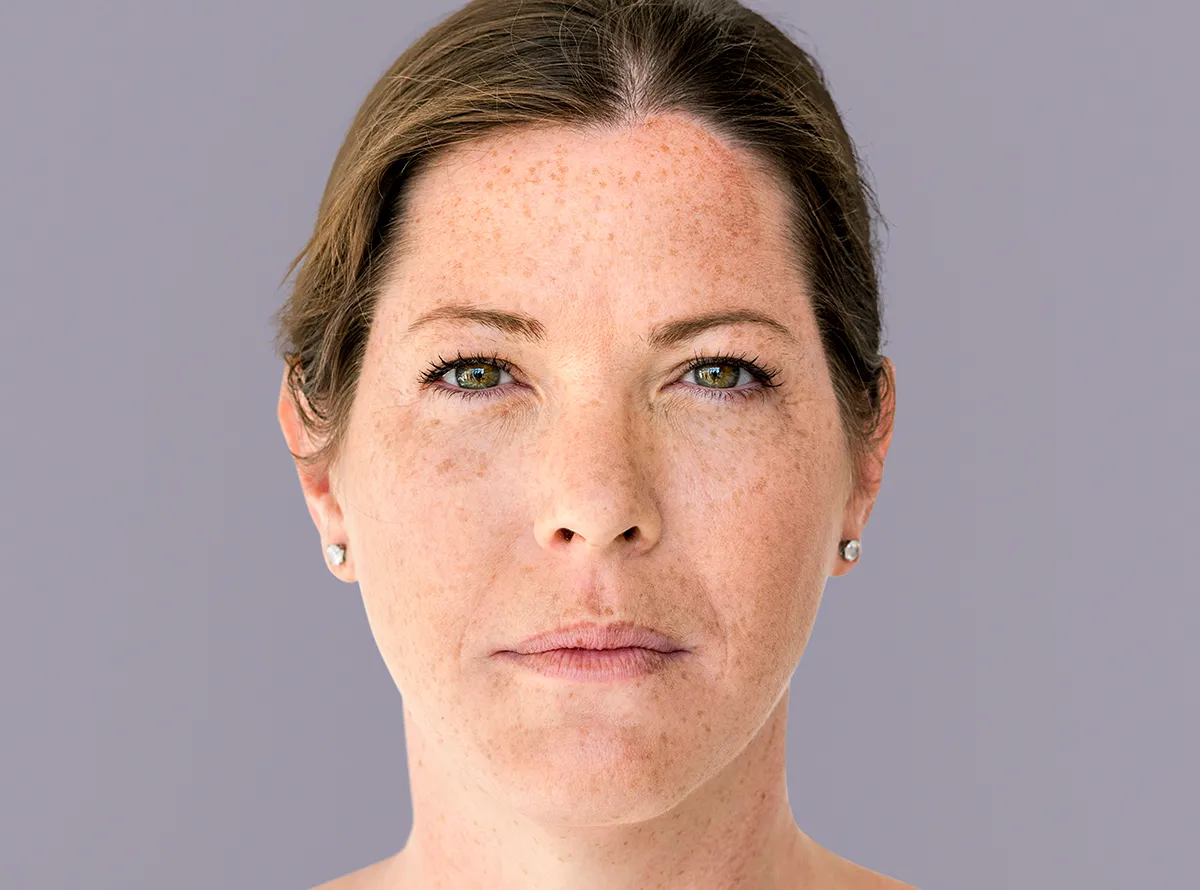 Freckle removal treatment at Dermatrix Clinic 1200x890