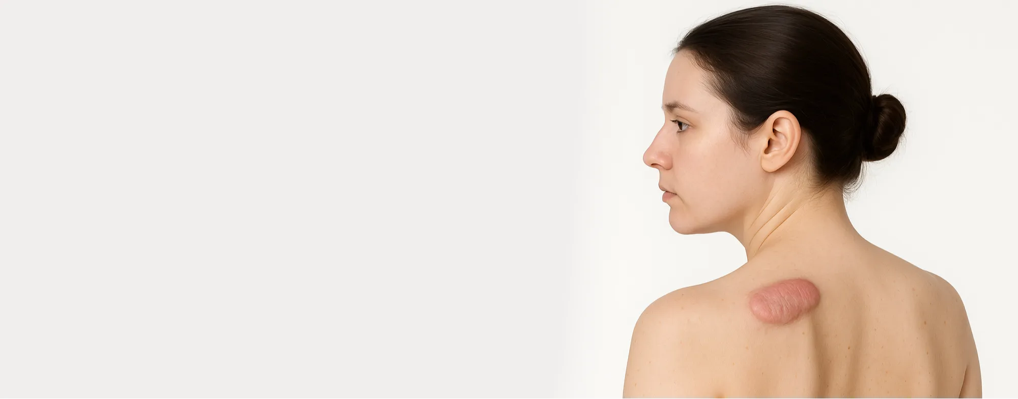 Keloid scar removal treatment banner at Dermatrix clinic in Thane and Mumbai showing a large keloid on a patient shoulder 2000x785