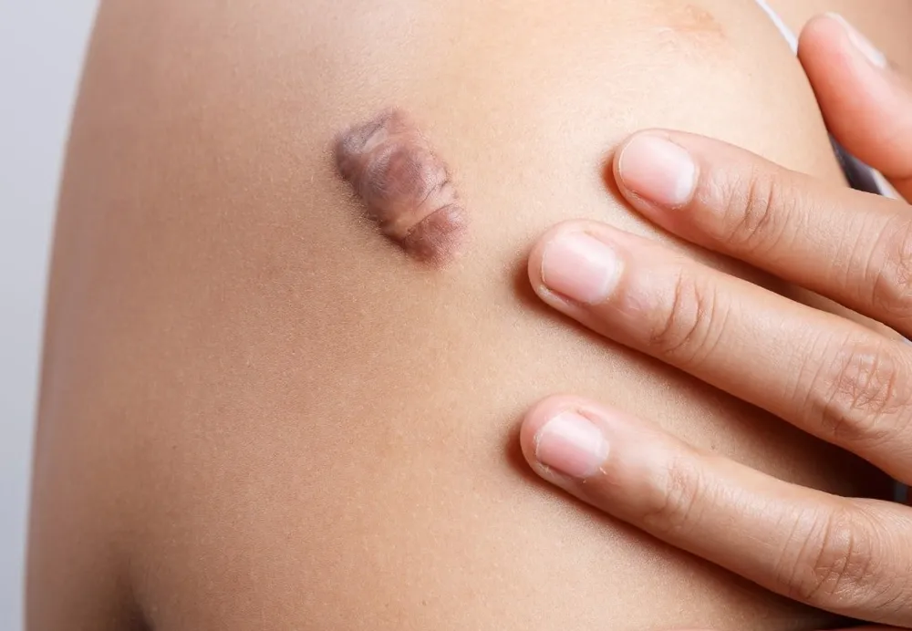 Best keloid scar removal treatment in Mumbai and Thane by Dermatrix skin clinic 1000x692