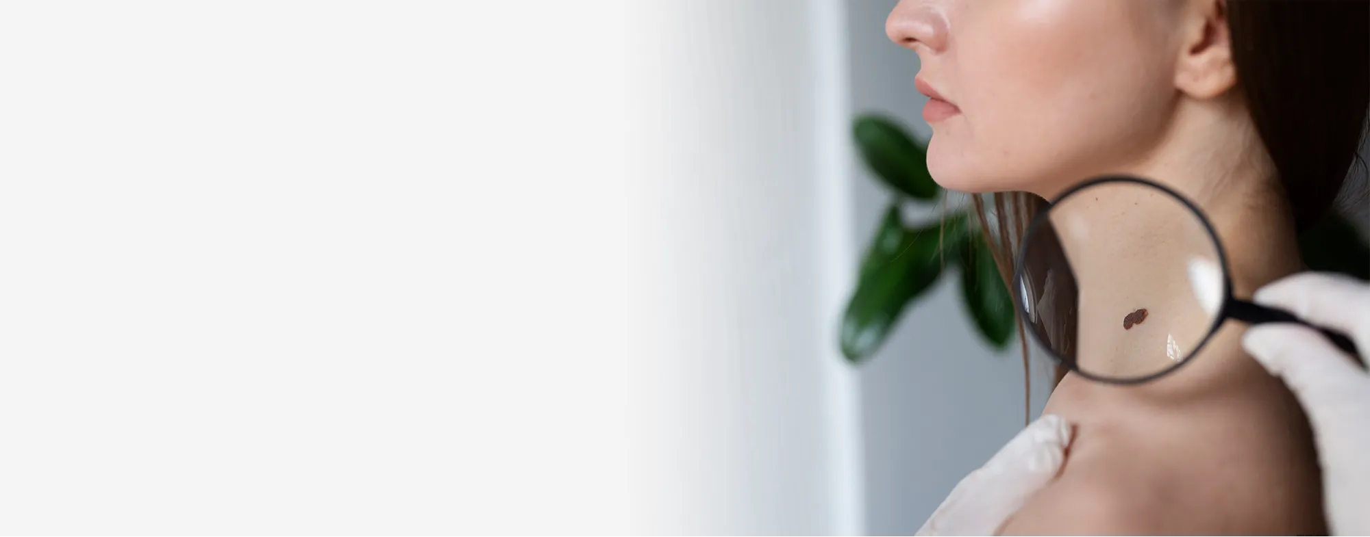 Mole removal treatment at Dermatrix clinic in Thane and Mumbai 2000x785