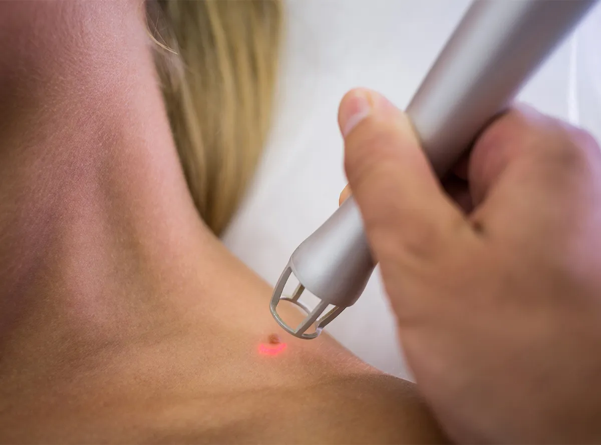 Laser mole removal treatment on a patient's neck at Dermatrix Clinic Thane and Mumbai 1200x890