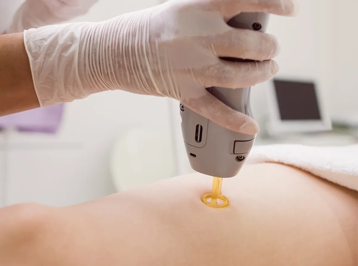 Stretch marks removal Dermatrix clinic Thane Mumbai 1200x890