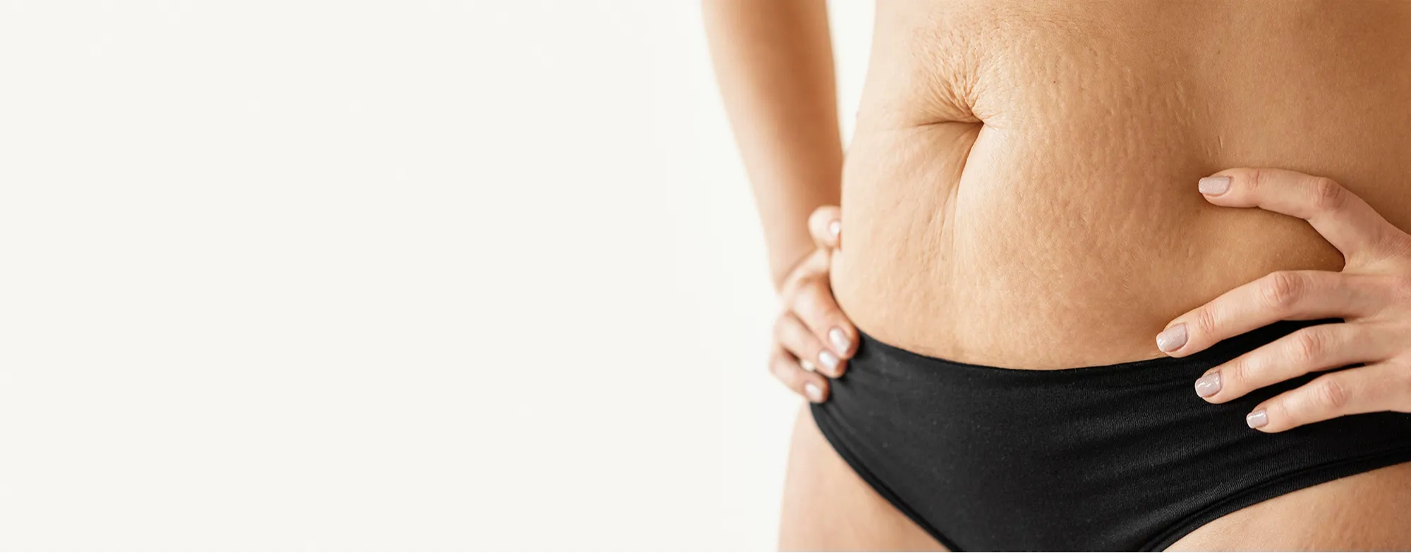 Stretch marks removal treatment at Dermatrix clinic in Thane and Mumbai 2000x785