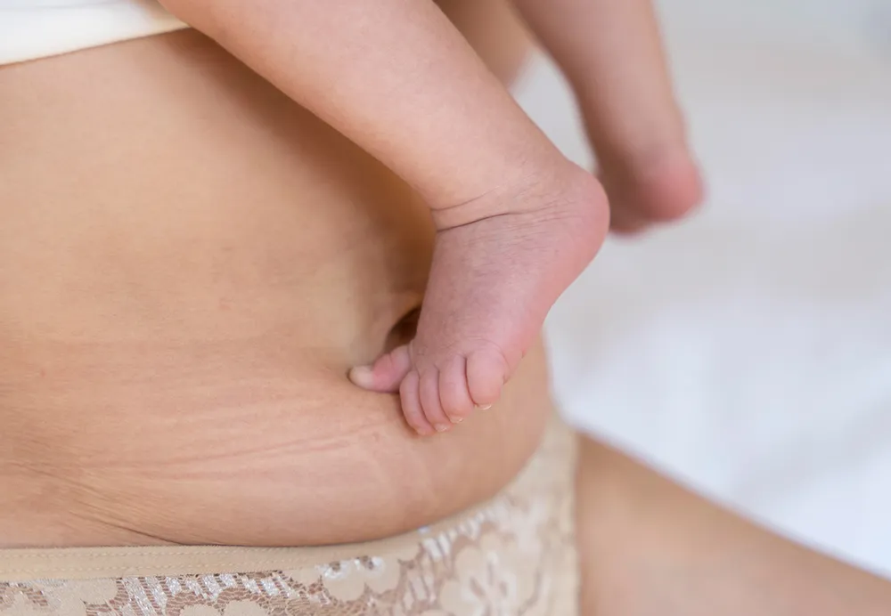 Dermatrix clinic website banner for stretch marks removal treatment showing a woman abdomen 1000x692