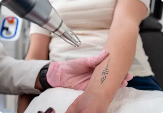 Dermatologist performing laser tattoo removal at Dermatrix Clinic Mumbai and Thane 520x360