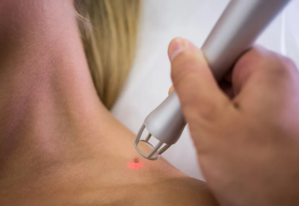 Wart removal treatment at Dermatrix Clinic in Thane and Mumbai 1000x692