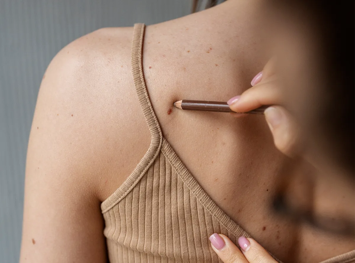 Dermatologist performing wart removal examination at Dermatrix Clinic Mumbai 1200x890