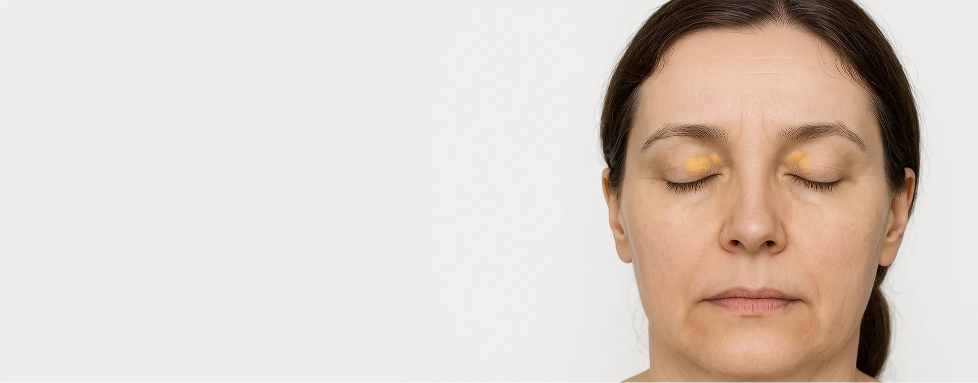 Xanthelasma removal treatment banner at Dermatrix skin clinic in Thane and Mumbai 2000x785