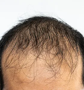 Hair Regenera 280x300