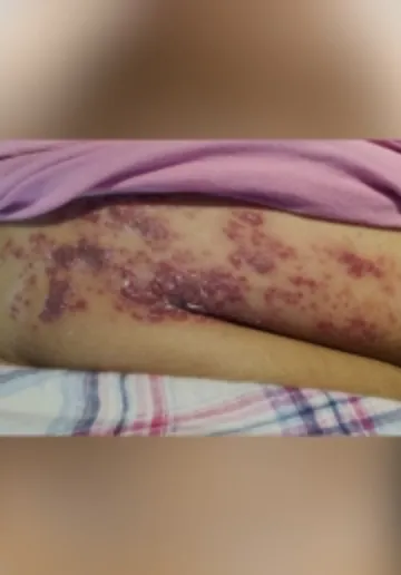 Acne Treatment Before and after results at Dermatrix Clinic