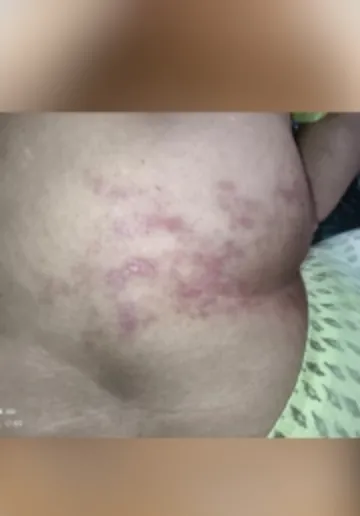 Acne Treatment Before and after results at Dermatrix Clinic