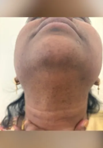 Facial Hair Removal Before and after results at Dermatrix Clinic