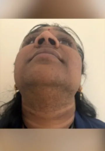 Facial Hair Removal Before and after results at Dermatrix Clinic