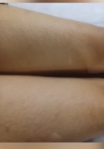 Leg Laser Hair Removal Before and after results at Dermatrix Clinic