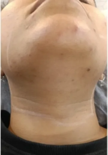 Facial Hair Removal Before and after results at Dermatrix Clinic