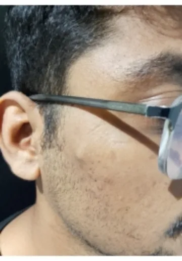 Cyst Removal Before and after results at Dermatrix Clinic