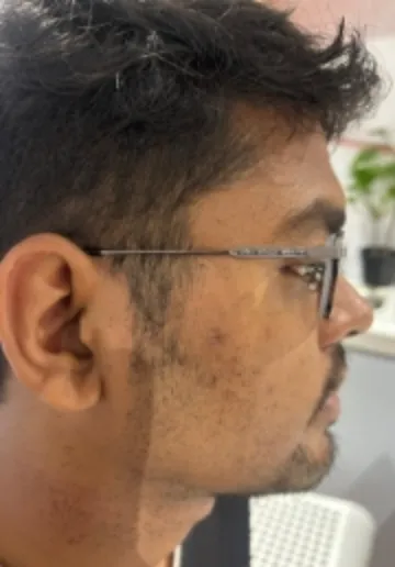 Cyst Removal Before and after results at Dermatrix Clinic