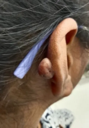Ear Piercing Before and after results at Dermatrix Clinic