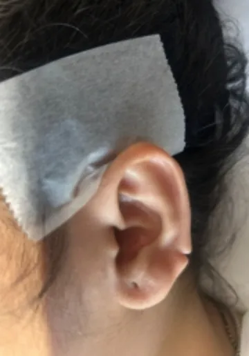 Ear Piercing Before and after results at Dermatrix Clinic