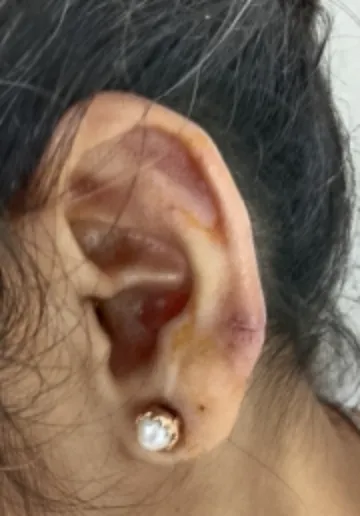 Ear Piercing Before and after results at Dermatrix Clinic