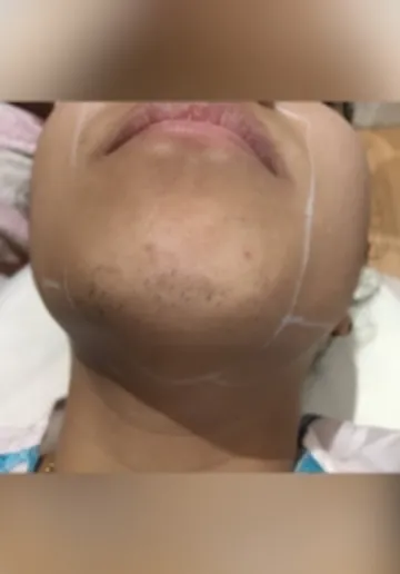 Laser Hair Removal Before and after results at Dermatrix Clinic