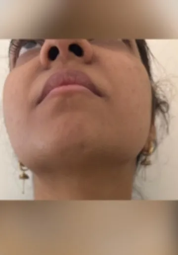 Laser Hair Removal Before and after results at Dermatrix Clinic