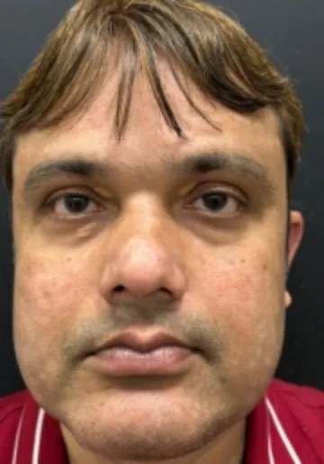 Xanthelasma Removal Before and after results at Dermatrix Clinic