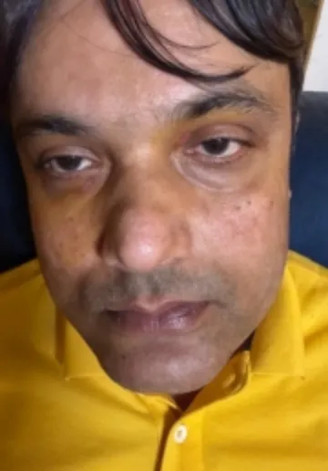 Xanthelasma Removal Before and after results at Dermatrix Clinic