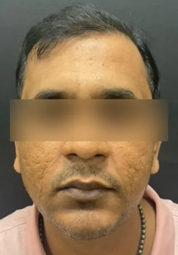 Thread Lifting Before and after results at Dermatrix Clinic