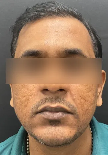 Thread Lifting Before and after results at Dermatrix Clinic