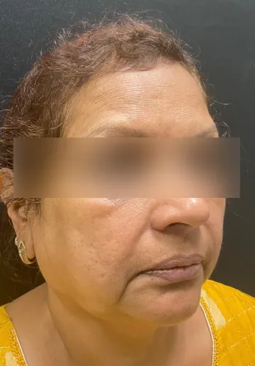 Thread Lifting Before and after results at Dermatrix Clinic