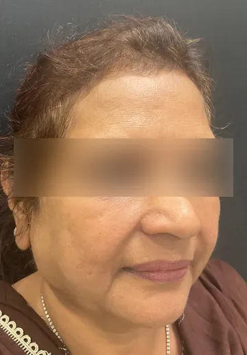 Thread Lifting Before and after results at Dermatrix Clinic
