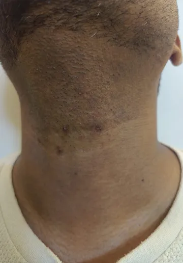 Wart Removal Before and after results at Dermatrix Clinic